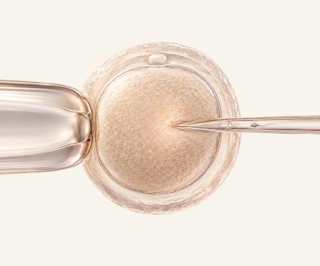 Ilustração de micromanipulação de um óvulo na técnica de ICSI.