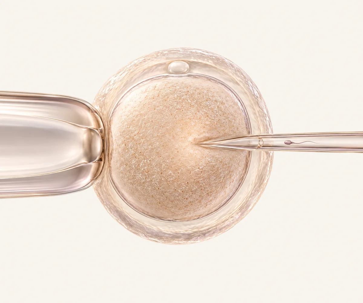 Ilustração de micromanipulação de um óvulo na técnica de ICSI.