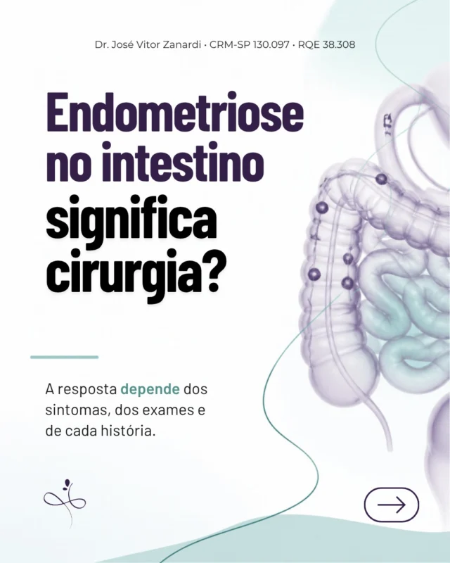 Endometriose no intestino significa cirurgia? Não necessariamente.

A decisão não depende apenas do que aparece no exame. Os sintomas, a resposta ao tratamento, o comprometimento intestinal e os planos de cada paciente precisam ser considerados.

É por isso que eu insisto que não existe receita pronta, e sim uma paciente, com uma história que precisa ser ouvida e um cuidado que precisa ser individualizado.

No carrossel, explico o que avaliar antes de definir o caminho, e te convido a ler a postagem no blog do site, sobre o assunto. Link na bio.

Dr. José Vitor Zanardi
CRM 130.097 | RQE 38308